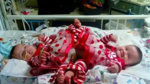 День сиамских близнецов