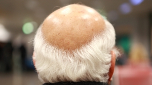 День блестящей лысины